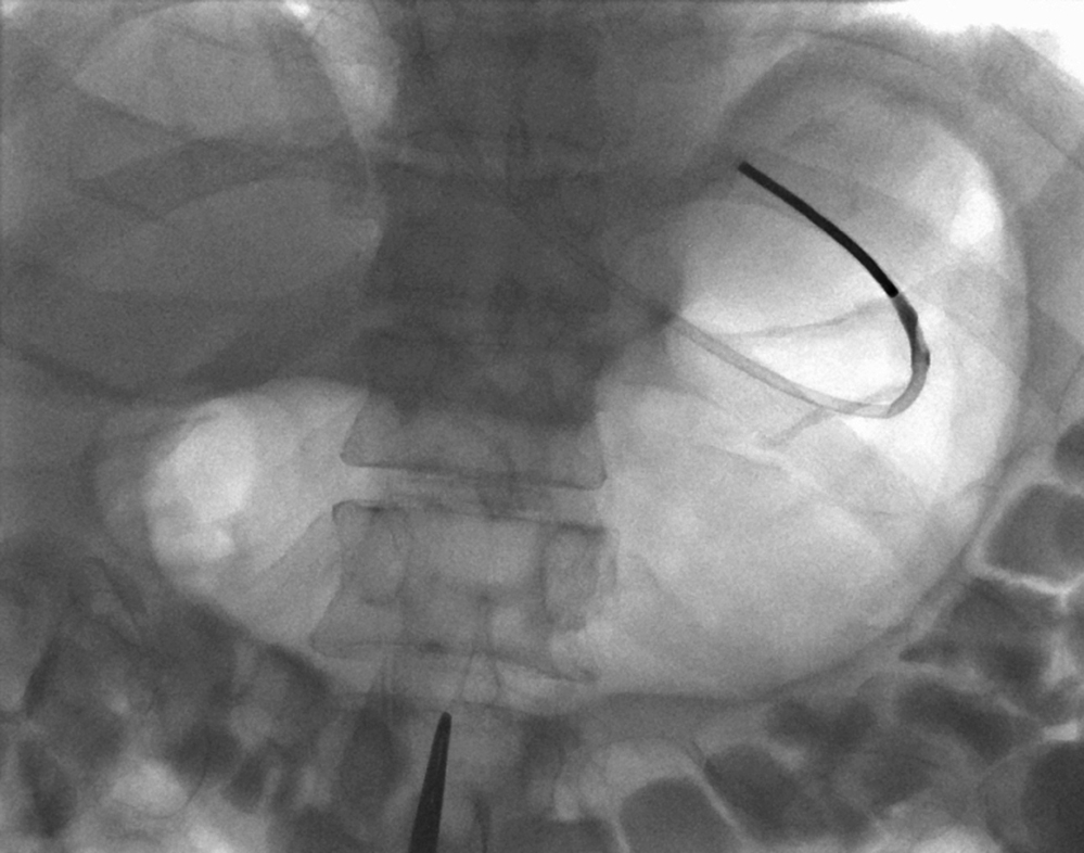 Fig. 91.1, Before gastropexy, the stomach is well distended after intravenous hyoscine butylbromide and air insufflation via in situ nasogastric tube. Barium opacifies the transverse colon after administration the day before the procedure. The puncture site is selected, ideally within the fundus, with a tract passing through the rectus abdominus muscle belly.