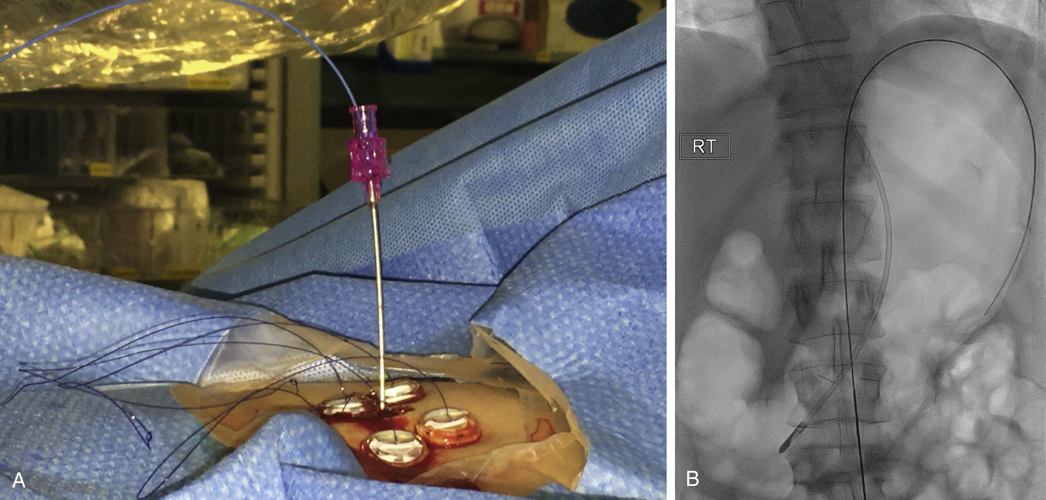 Fig. 91.3, (A) An 18-gauge needle is similarly used to puncture the stomach under fluoroscopy. After air is aspirated to confirm position within the gastric lumen, a short stiff wire (such as an Amplatz Super Stiff wire) is advanced through the needle into the stomach. (B) A vascular access needle passes through the center of the gastropexy clips, through which the wire is passed. The shape of the wire conforms to the shape of stomach outline.