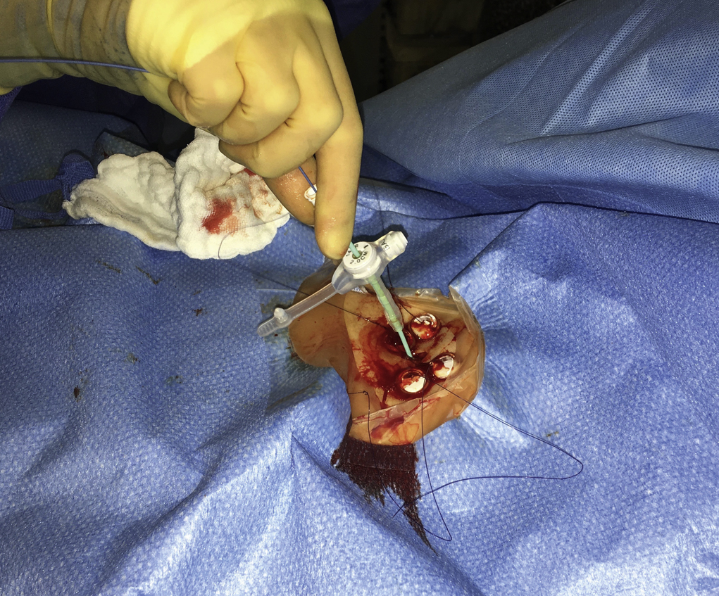 Fig. 91.5, After tract length measurement and selection of the appropriate tube length, the chosen gastrostomy can be mounted on a 6F dilator and advanced over the wire into the stomach.