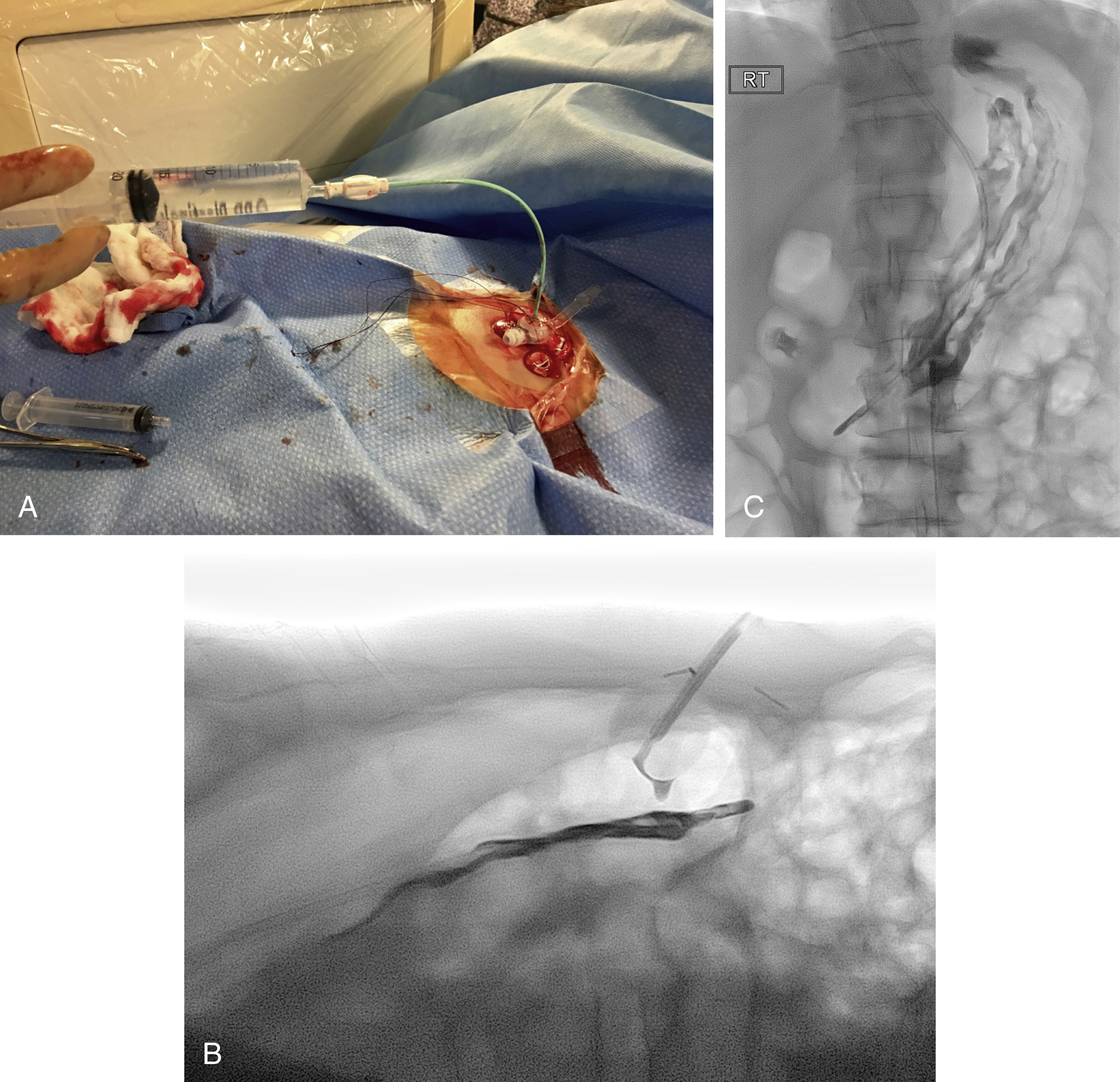 Fig. 91.7, (A) While screening in the lateral position, contrast is injected through the tip of a dilator into the gastrostomy tube. (B) Fluoroscopy in the lateral position demonstrates contrast flowing through the balloon gastrostomy tube into the gastric lumen. The position of the balloon entirely within the gastric lumen is well demonstrated. (C) Corresponding frontal fluoroscopic image outlines the gastric folds, with no evidence of peritoneal leakage.