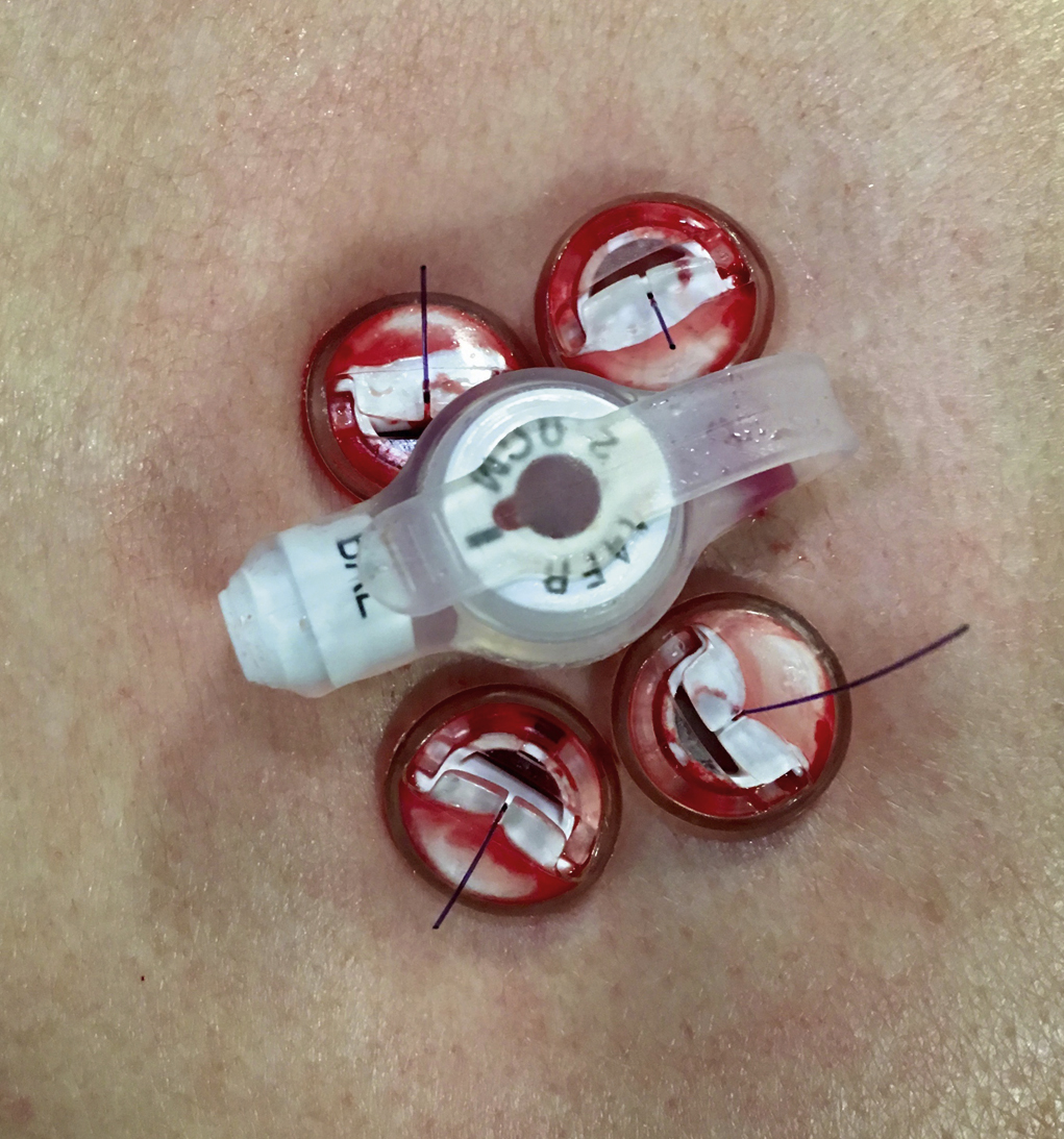 Fig. 91.8, Postinsertion image of the anterior abdominal wall demonstrating the central position of a balloon gastrostomy tube (14F 2.0-cm MIC-KEY button gastrostomy tube, Halyard Health, Alpharetta, GA) relative to the gastropexy sutures (SAF-T-PEXY T-fasteners, Halyard Health).