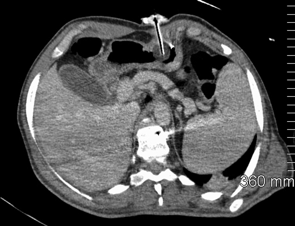 Fig. 91.9, Axial computed tomography demonstrating the expected position of a balloon gastrostomy tube (MIC-KEY button, Halyard Health, Alpharetta, GA) passing through the anterior abdominal wall, left rectus abdominus muscle, and the anterior gastric wall. The balloon inflated within the gastric lumen.