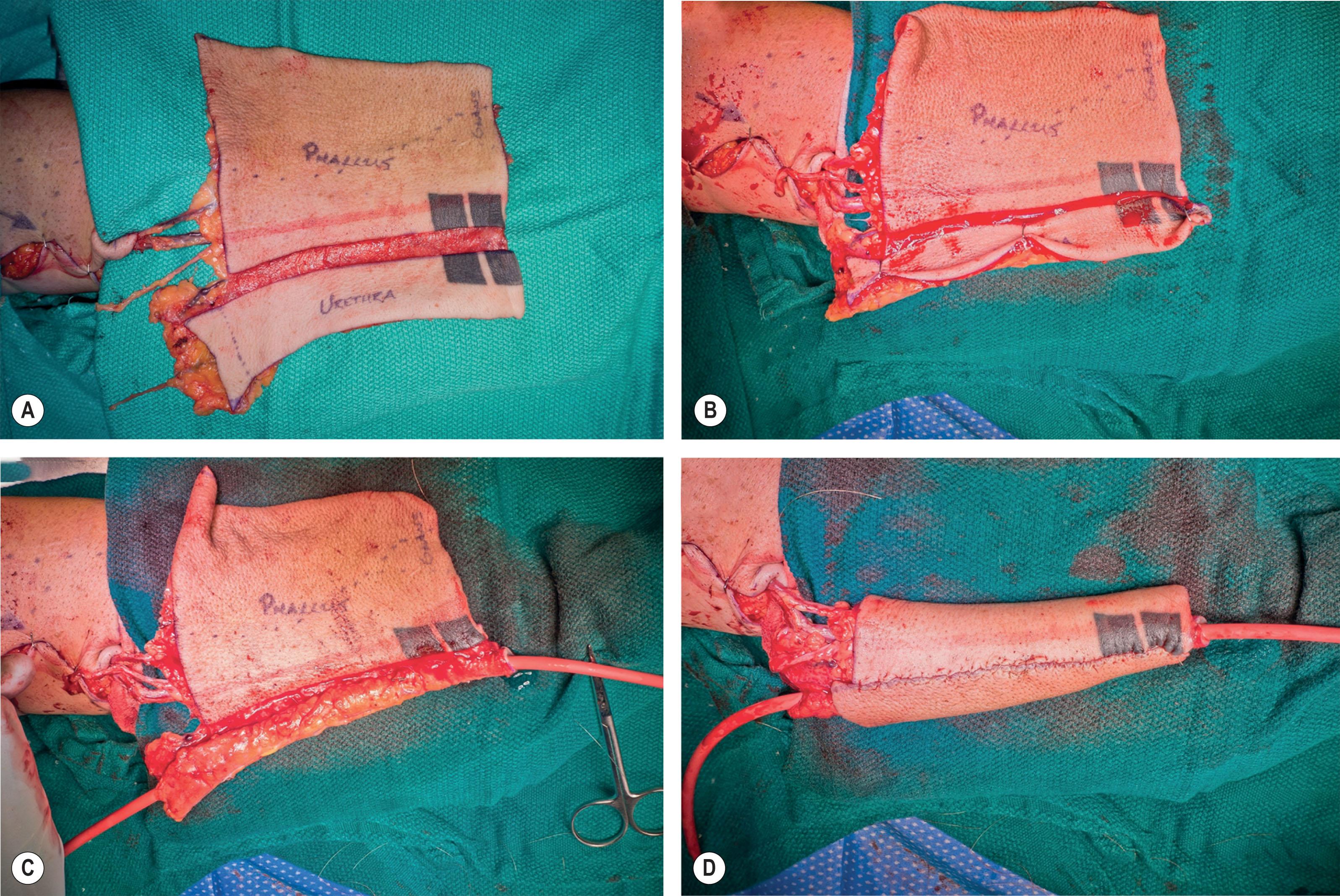 Figure 14.3.11, Flap tubularization. (A) Native flap. (B,C) Tubing of urethra. (D) Subsequent closure of shaft.