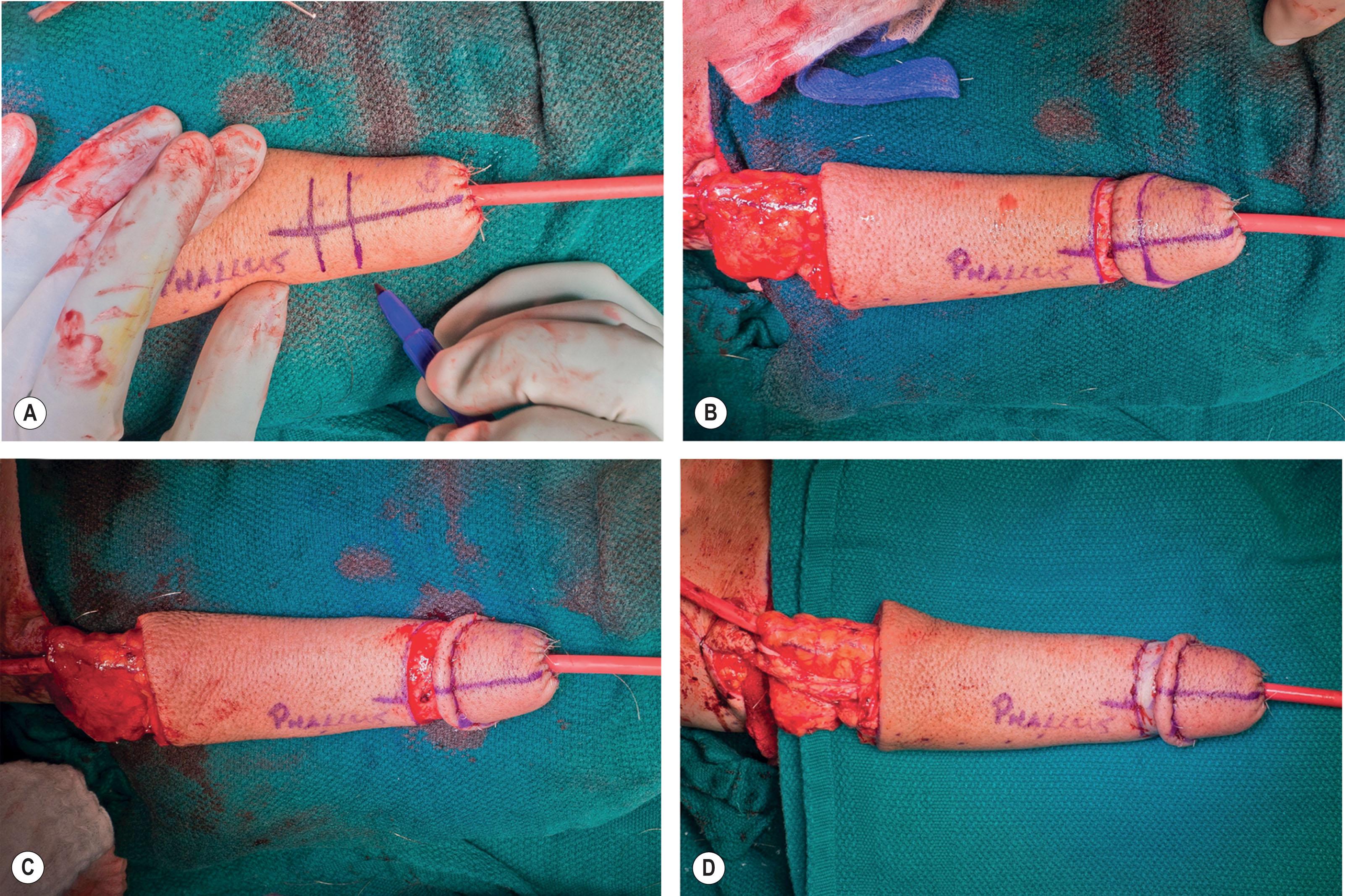 Figure 14.3.12, Glansplasty. (A) Glansplasty design. (B) Full-thickness flap elevation in a subdermal plane to create coronal ridge. (C) Coronal ridge shaping sutures. (D) Skin grafting of residual defect using prior skin harvested from radial forearm flap harvest.