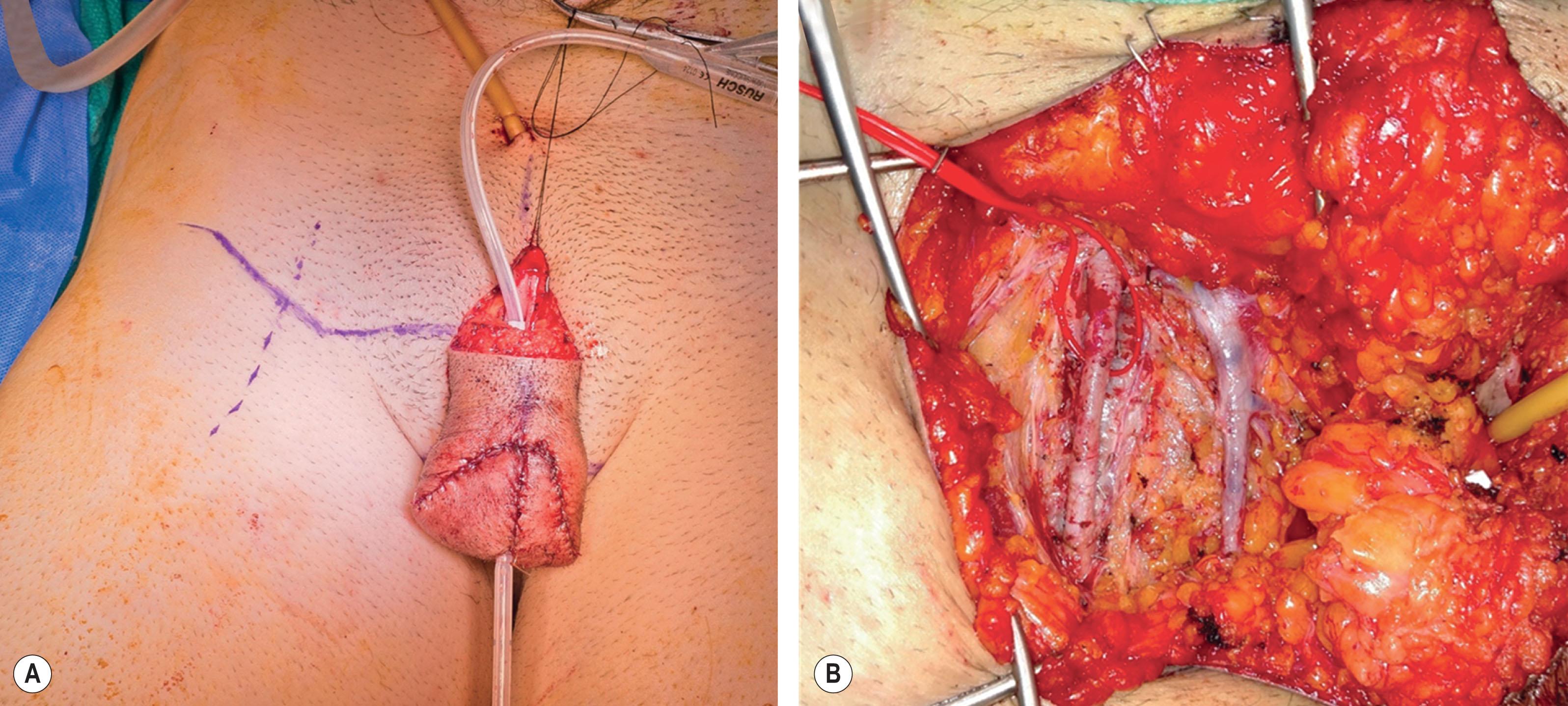 Figure 14.3.13, Groin vessel preparation. (A) An extension is made laterally toward groin vessels. (B) Exposure of superficial femoral artery and saphenous vein.