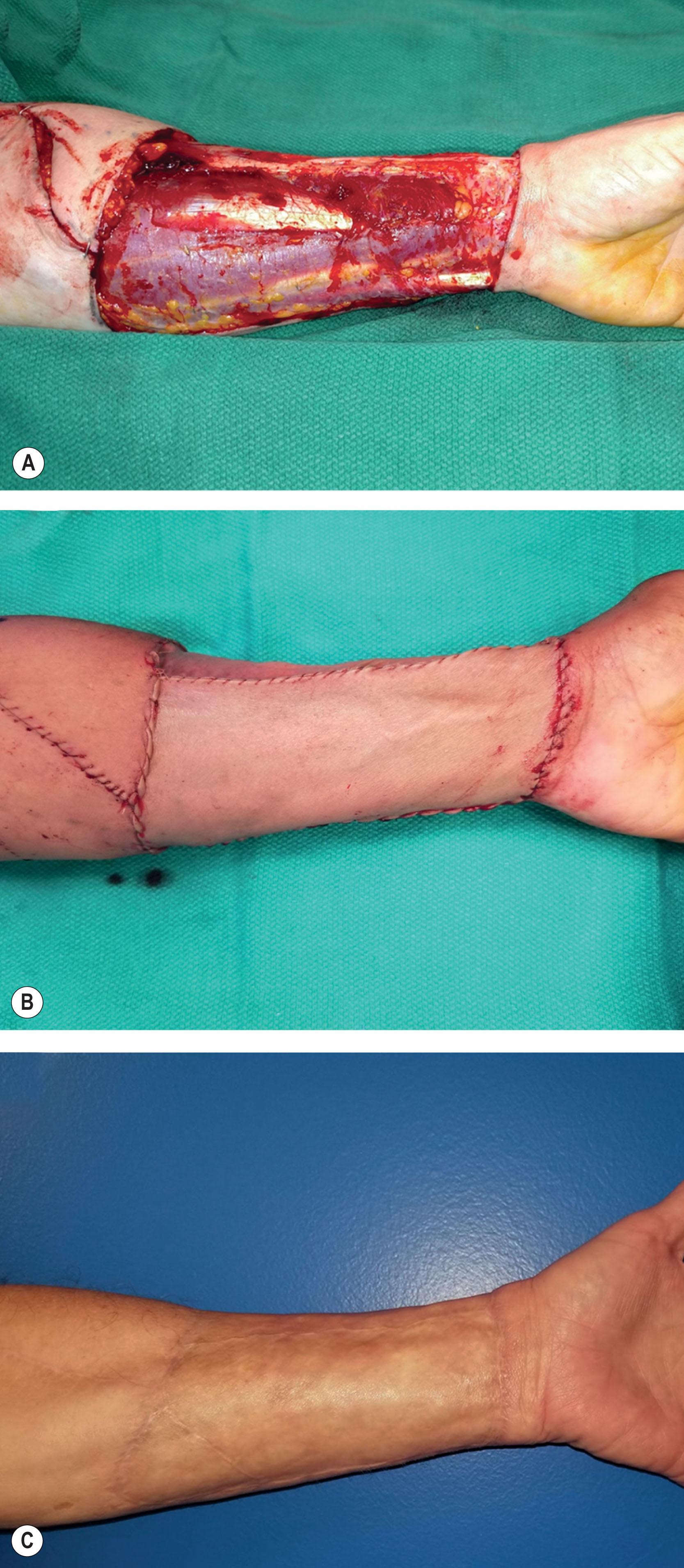 Figure 14.3.14, Radial forearm flap donor site closure. (A) Distal FCR tendon is covered with imbrication of adjacent FPL muscle belly. (B) Split-thickness sheet graft from thigh is inset. (C) Late postoperative result of forearm healing.