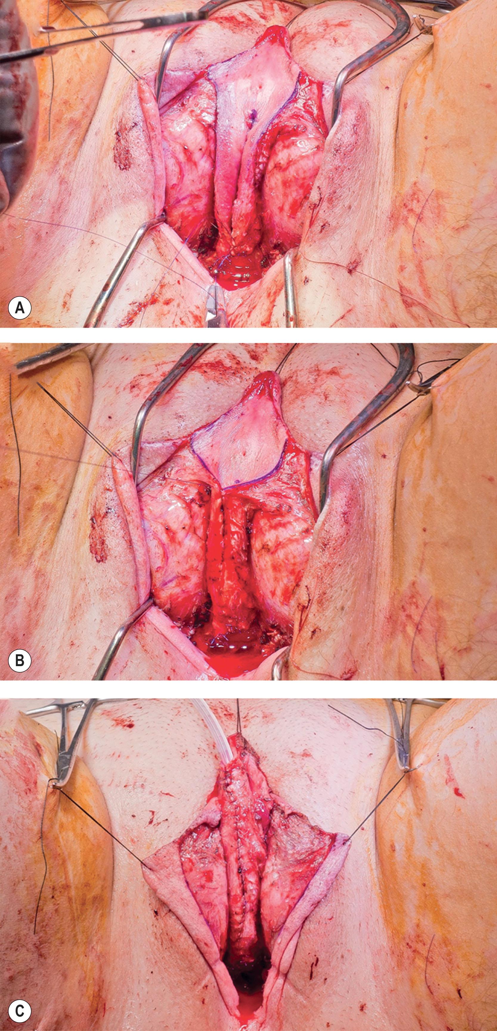 Figure 14.3.2, Tubularization of labia minora flaps for pars fixa reconstruction. (A) Dissection of labia minora flaps. (B) Tubularization and closure. (C) Completed tubularization over urinary catheter.