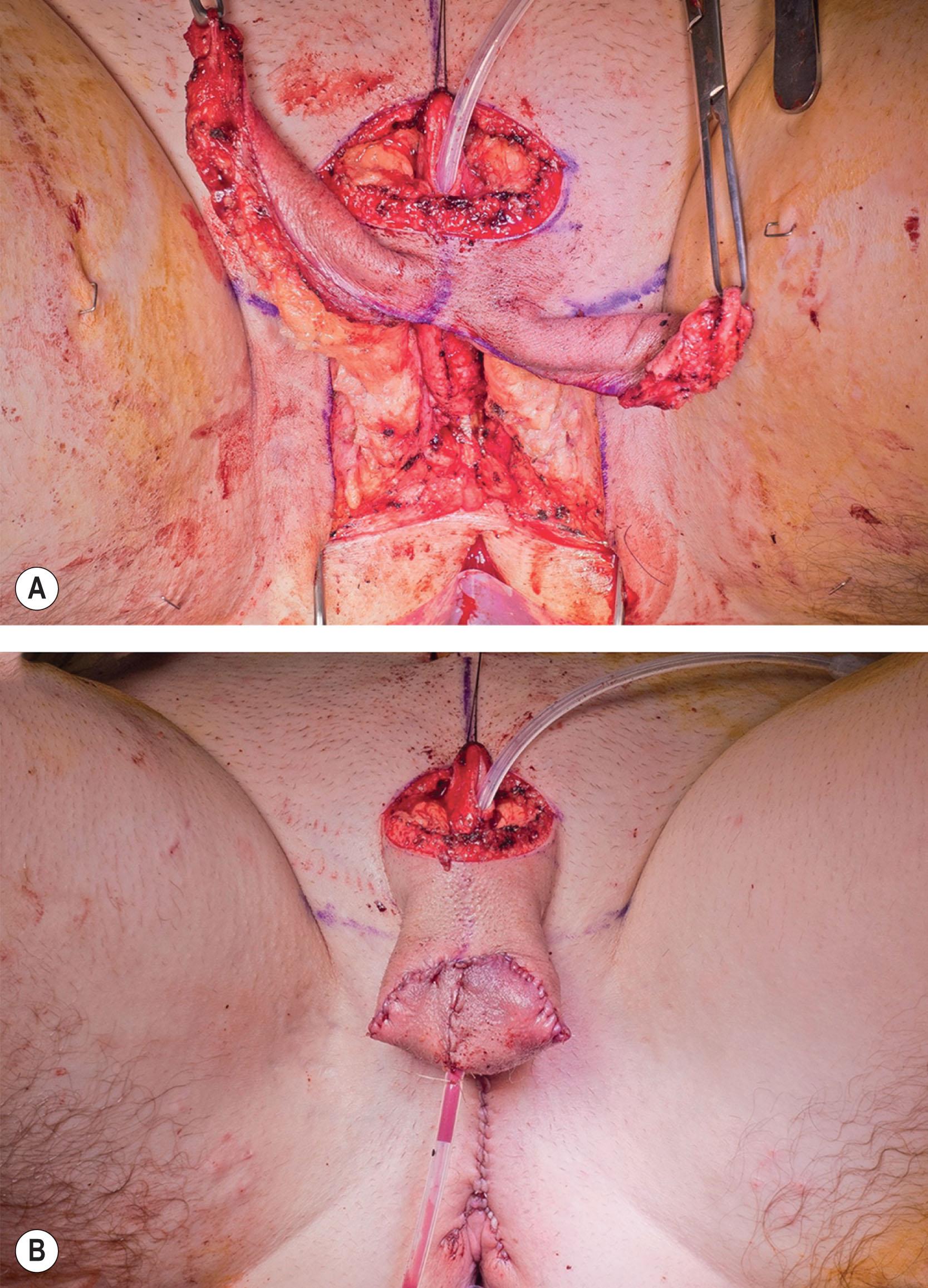 Figure 14.3.4, Scrotoplasty using labia majora fasciocutaneous flaps. (A) After dissection of labial flaps. (B) After perineal closure and scrotoplasty closure.