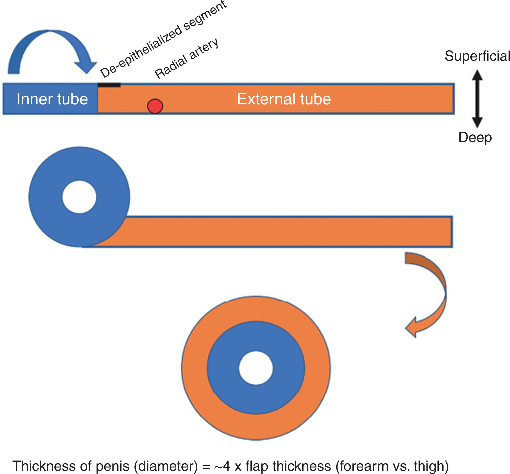 Figure 14.3.5, Relationship between flap thickness and ultimate phalloplasty dimensions. It is important to consider that incremental increase in thickness of the flap eventually translates to a theoretical 4× increase in final width.