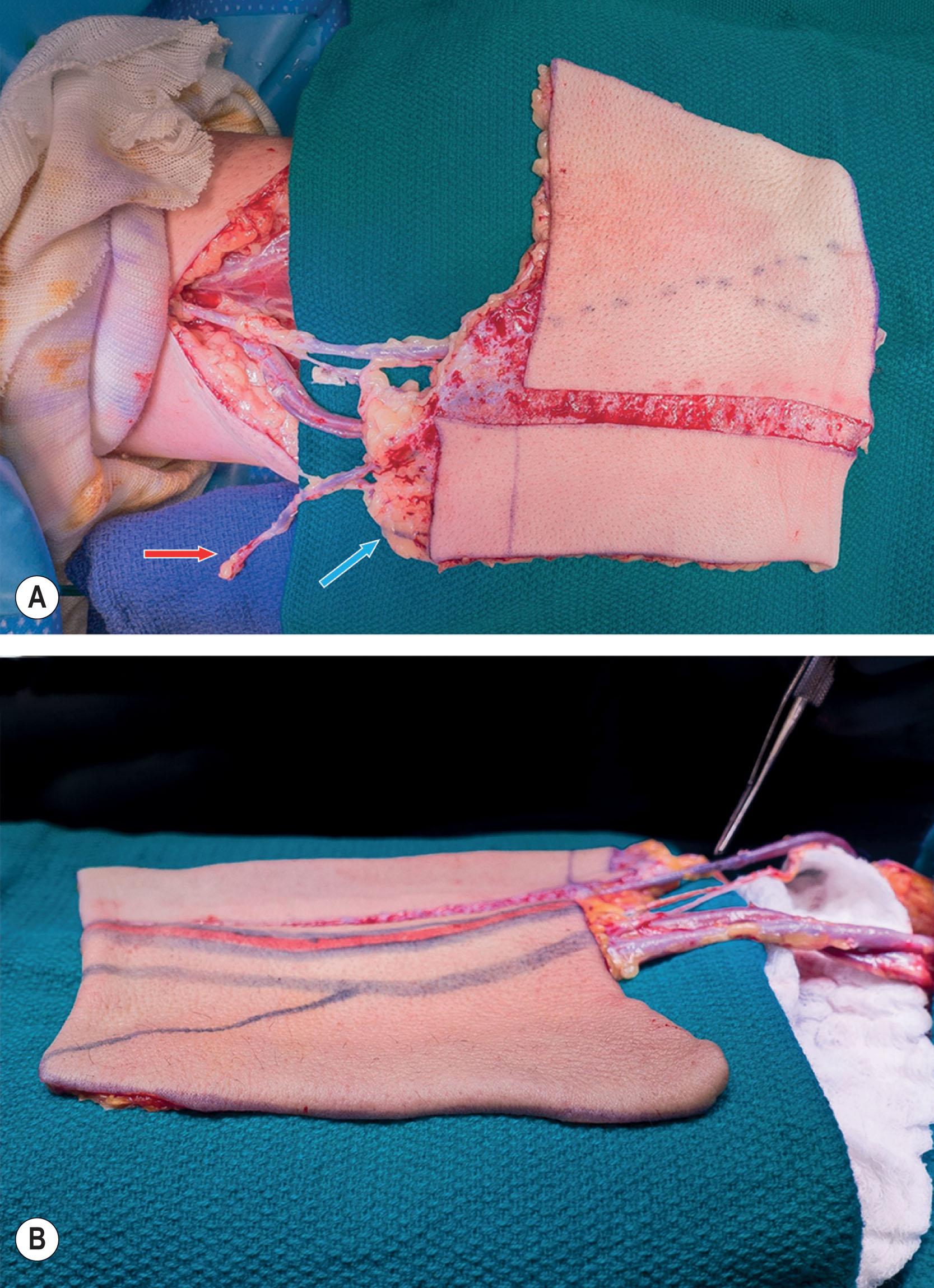 Figure 14.3.7, Radial forearm phalloplasty after elevation. (A) Note inclusion of additional outflow vein corresponding to urethral component of flap (red arrow) in addition to additional perfused proximal adipofascial tissue to reinforce eventual urethral anastomosis (blue arrow). (B) The radial forearm phalloplasty most reliably yields a thin and pliable flap.