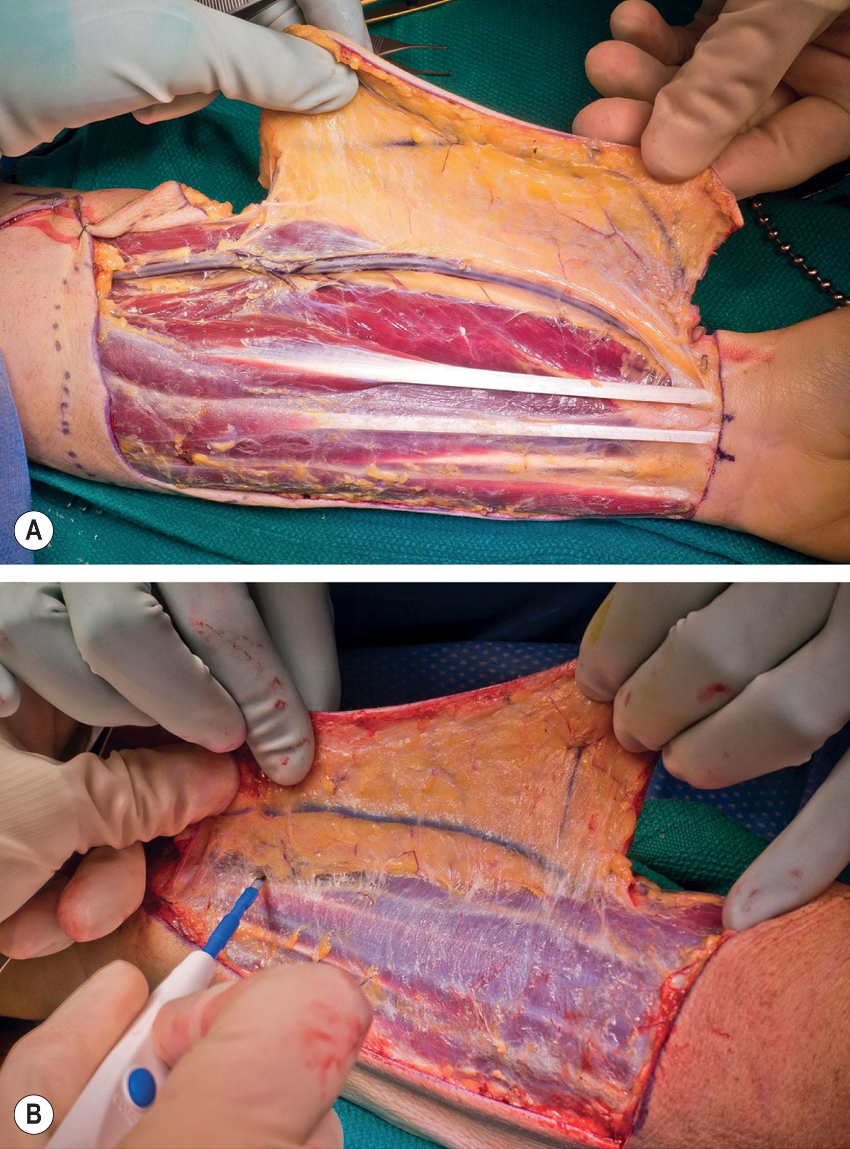 Figure 14.3.8, Standard radial forearm flap elevation technique. (A) Volar forearm with subfascial dissection radial to flexor carpi radialis (FCR). (B) Extended dorsal forearm dissection for shaft coverage.