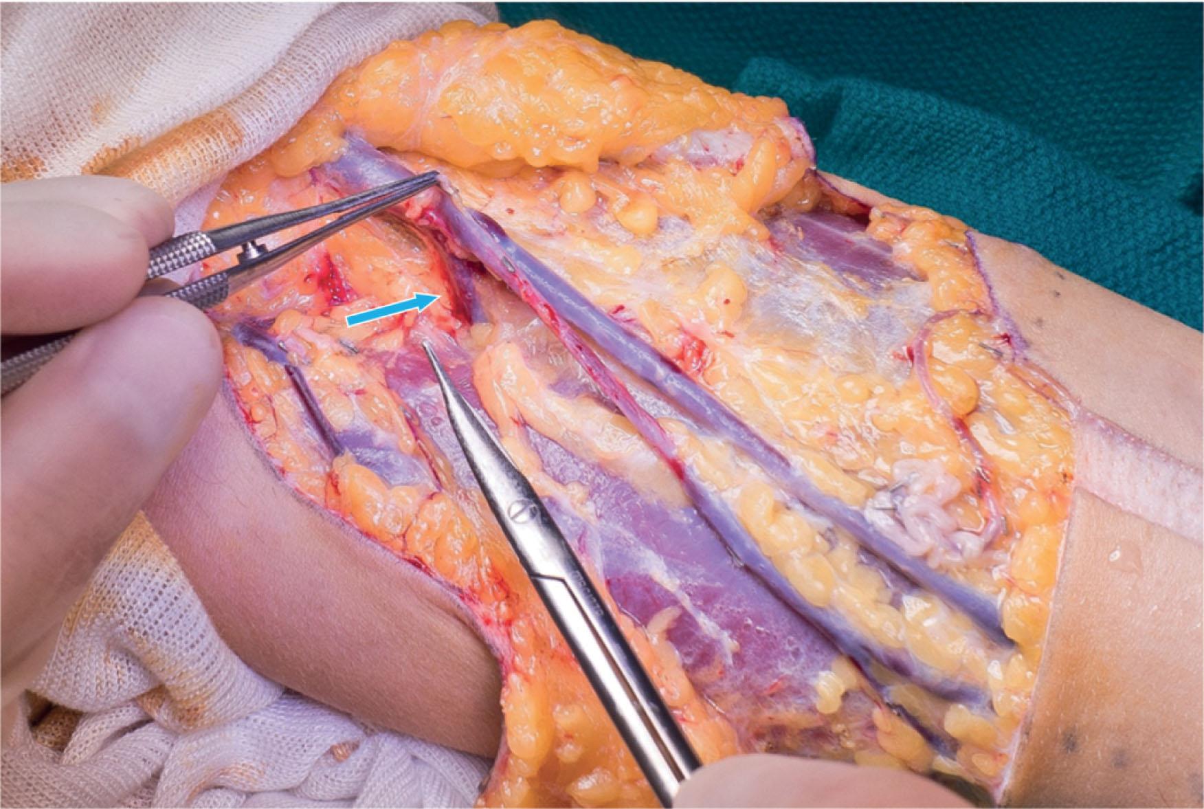 Figure 14.3.9, Proximal forearm dissection. Care is taken to preserve deep cubital vein (blue arrow) to combine the superficial venous drainage with the radial artery venae comitantes to maximize venous outflow.