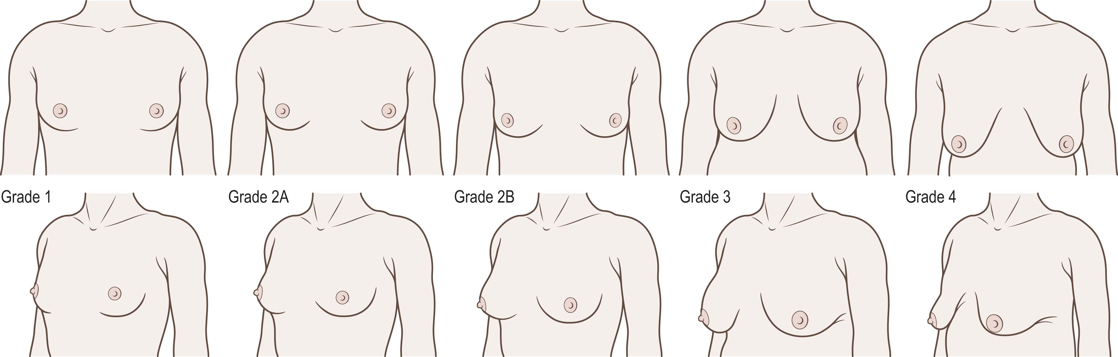 Figure 39.2, Fischer breast grading scale.