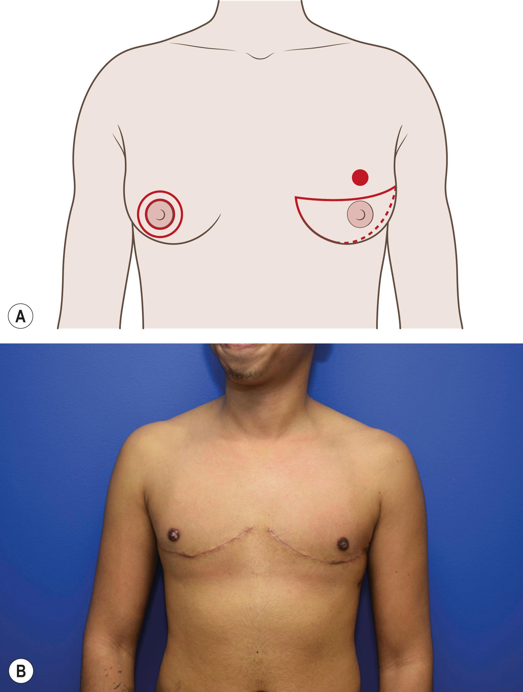 Figure 39.3, Preoperative markings for mastectomy. (A) Preoperative markings for mastectomy: double incision and free nipple graft markings (patient left) and circumareolar markings. (B) Surgical outcomes after mastectomy with double incision and free nipple graft. Note areolar depigmentation (6 months follow-up).