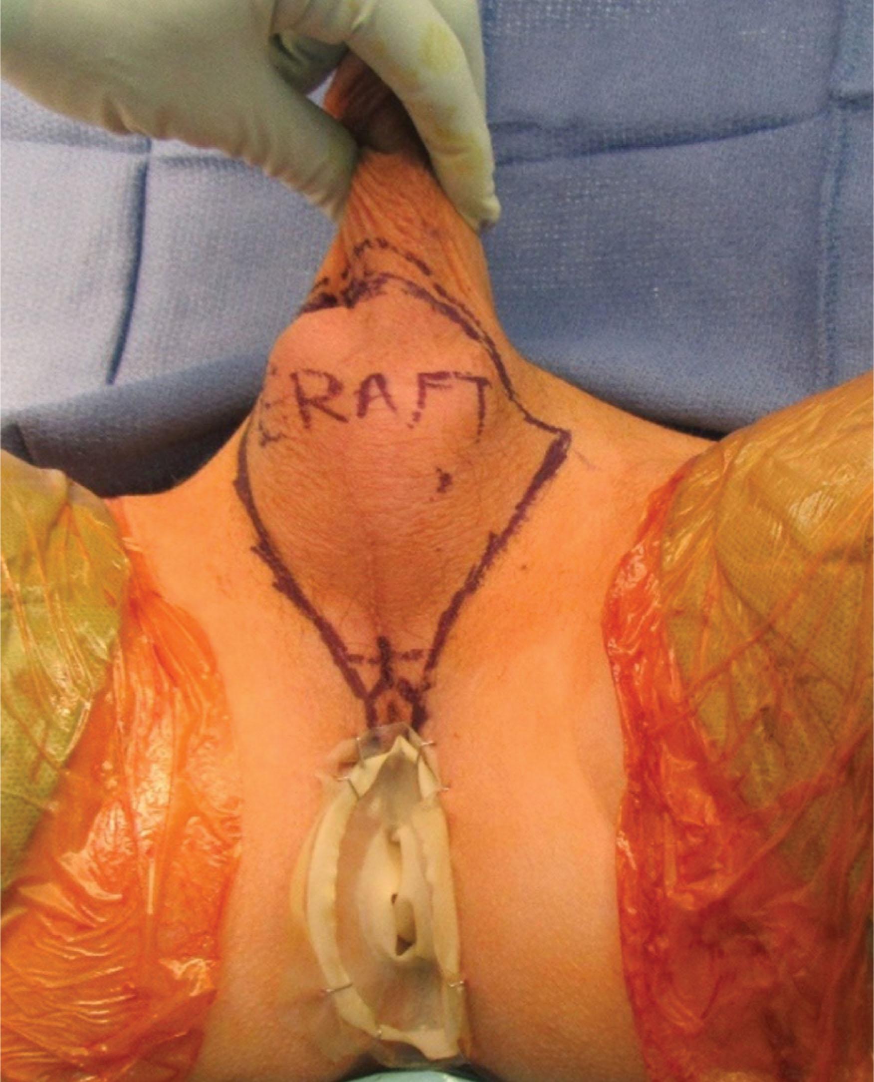 Figure 14.2.3, Preoperative marking for vaginoplasty.