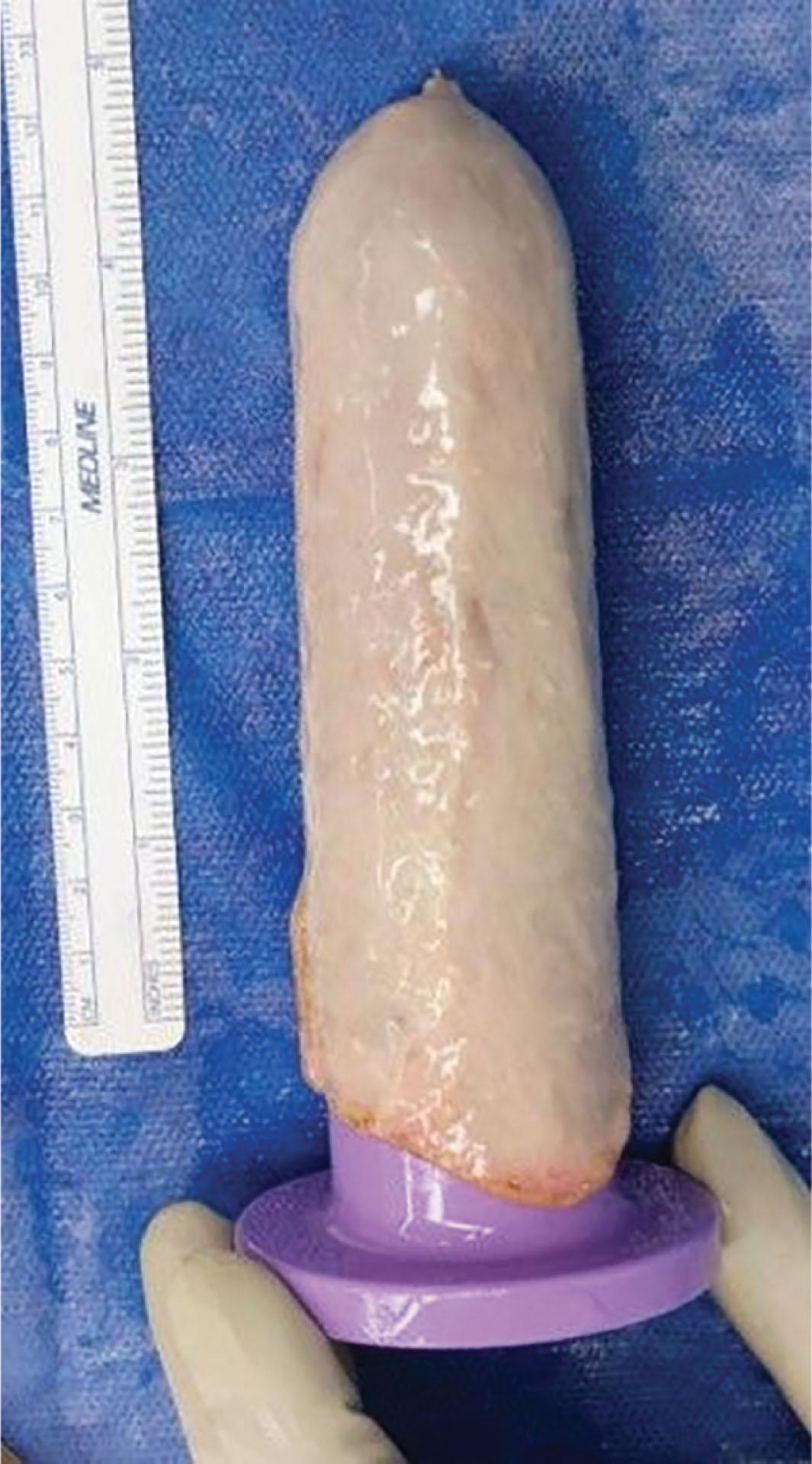 Figure 14.2.4, Preparation of skin graft for vaginoplasty.