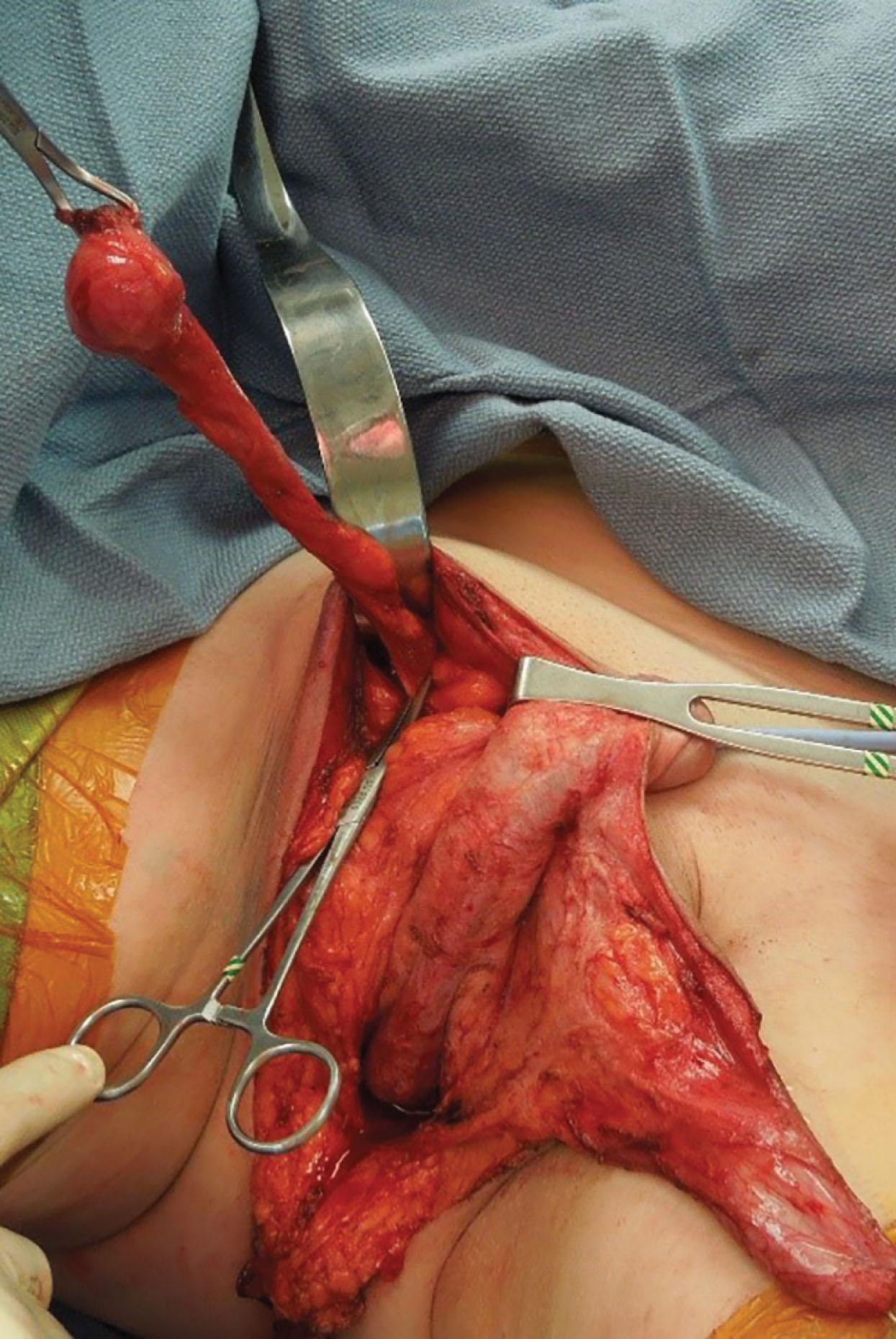 Figure 14.2.5, Bilateral orchiectomy.