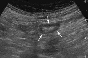 F igure 9-2, Normal colon. Transverse view of the colon shows the typical bull's-eye appearance of collapsed bowel (arrows) .