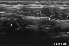 F igure 9-18, Normal appendix. Longitudinal view shows a normal appendix (cursors) measuring 5 mm arising from the cecum (C).