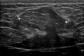 F igure 9-34, Periumbilical hernia containing fat. Longitudinal view shows a solid mass (cursors) that is isoechoic to the subcutaneous fat. The appearance is very similar to a lipoma. Video of the same area (see Video 9-17 ) during transducer compression shows partial reduction of the fat-containing hernia through a small fascial defect.