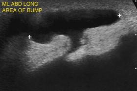 F igure 9-35, Fluid- and fat-containing hernia. Longitudinal view shows a fluid-filled hernia sac (cursors) communicating with ascites in the abdominal cavity through a small defect. Video of the same area (see Video 9-18 ) during transducer compression shows fluid and fat passing in and out of the hernia sac.