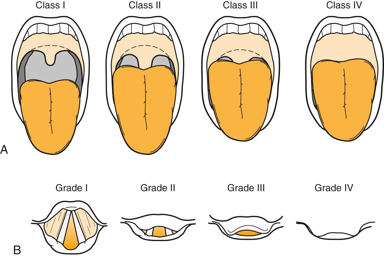 Fig. 5.2, Mallampati, Cormack, and Lehane oral (A) and laryngoscopic (B) views.