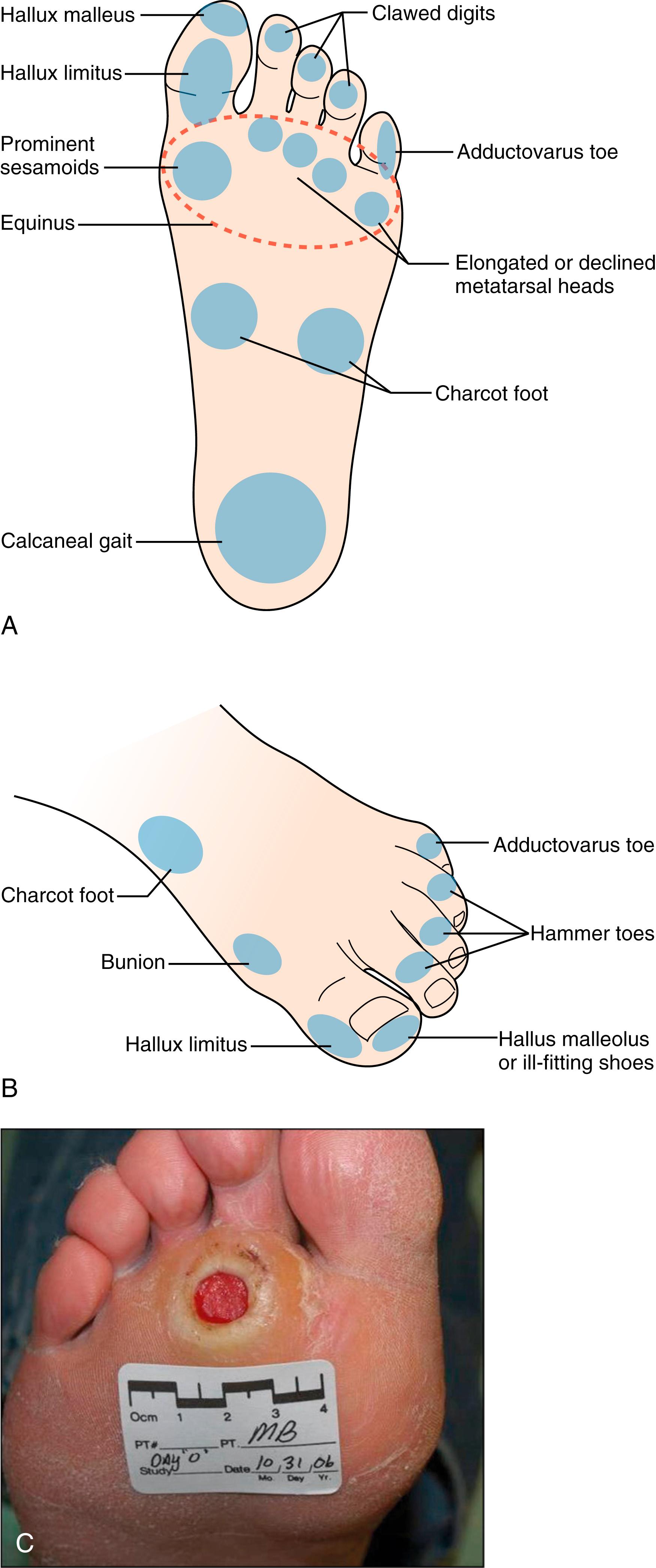 Figure 116.2, Locations of skin lesions on the diabetic foot with corresponding biomechanical etiologies related to the plantar ( A ) and dorsum ( B ) surfaces with an example of a diabetic dorsal foot wound ( C ). (C, Courtesy Vickie Driver, MD)