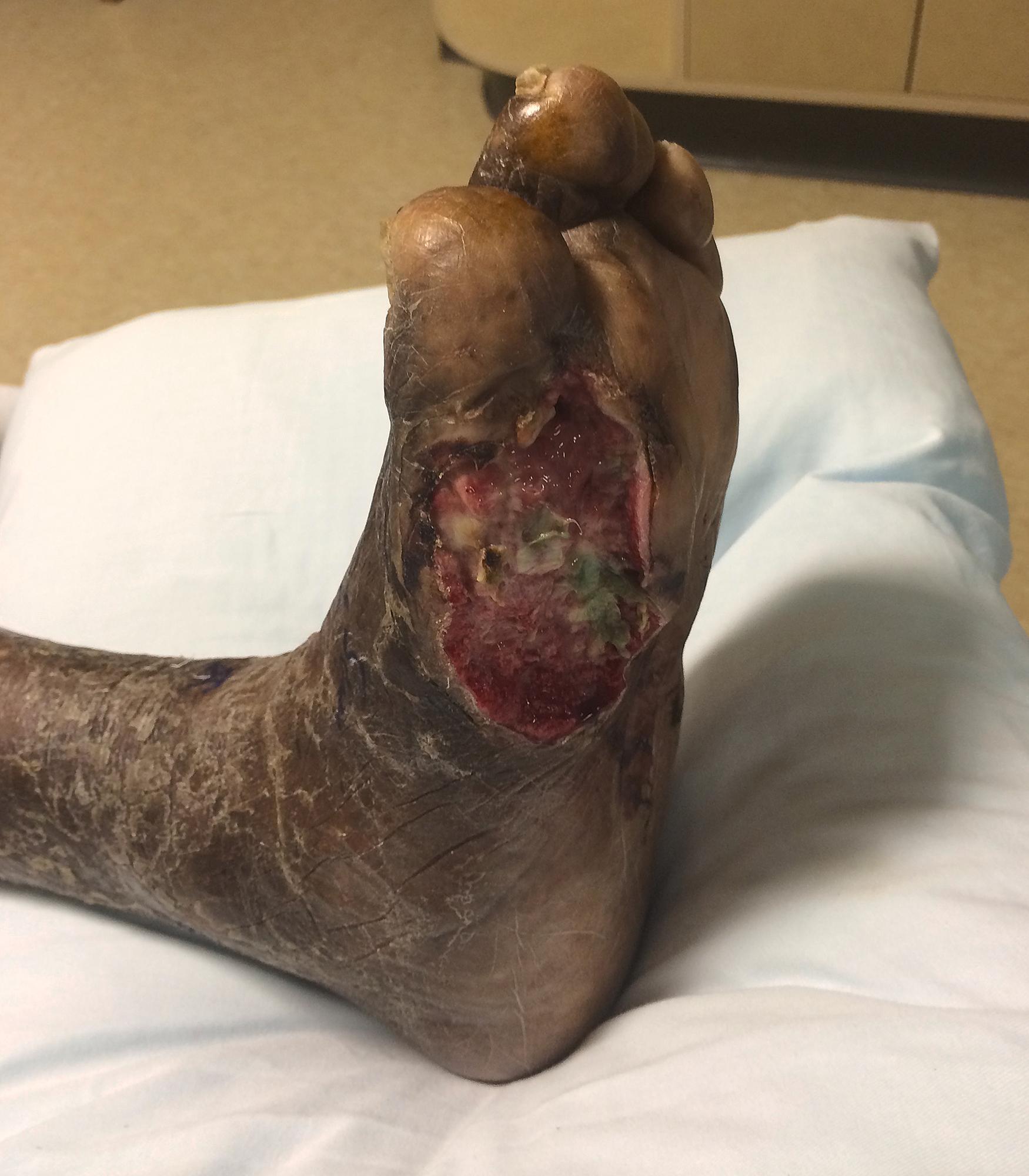 Figure 116.3, Diabetic foot ulceration with dry, brittle skin in an area of pressure.
