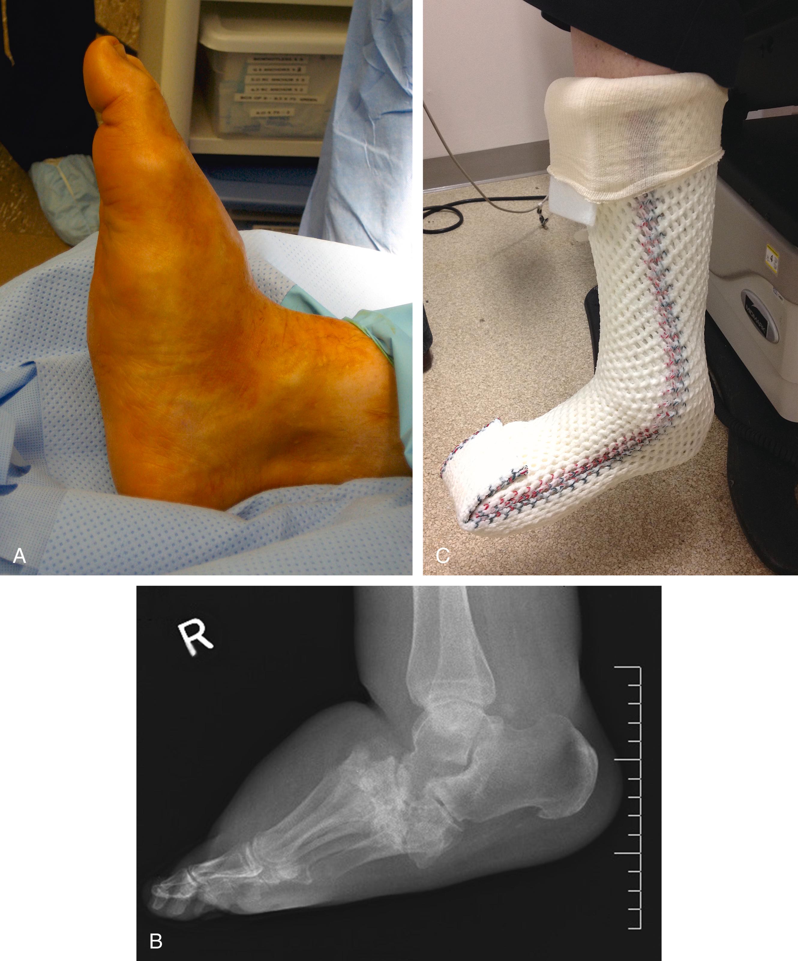 Figure 116.4, Charcot foot; typical “rocker bottom” appearance ( A ), characteristic X-ray ( B ), and offloading with total contact cast ( C ).