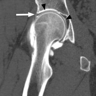 FIGURE 1–8, Using multidetector CT, arthrography can be performed without streak artifact using full-strength iodinated contrast. Coronal CT arthrogram of the hip outlining the acetabular labrum (arrow) and articular cartilage (arrowheads) .