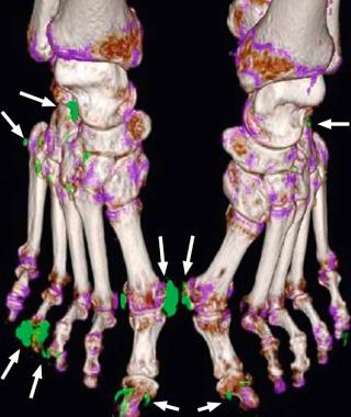 FIGURE 1–9, 3D reconstruction using dual-energy CT shows urate deposits at the forefoot and midfoot bilaterally (arrows) .