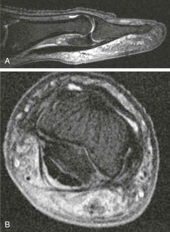 eFIGURE 1–4, A and B , High-resolution imaging of the thumb achieved using a microcoil on a 3-T scanner.