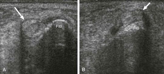 FIGURE 1–2, Demonstration of tendon subluxation. A , Transverse sonographic image through the lateral ankle shows the peroneus brevis tendon (arrow) posterior to the fibula (FIB) . B , On dorsiflexion, the tendon (arrow) dislocates from the fibular groove.