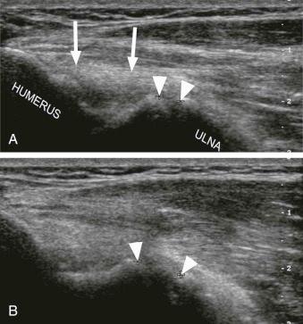 FIGURE 1–3, Valgus stress applied to the elbow demonstrating laxity of the ulnar collateral ligament. A , Longitudinal image through the medial elbow in a baseball pitcher shows a thickened ulnar collateral ligament (arrows) . The medial joint space is demarcated by arrowheads . B , With valgus stress applied, the medial joint space widens (arrowheads) .