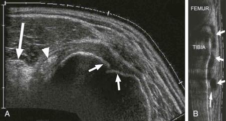 eFIGURE 1–2, Use of extended field of view (EFOV) in ultrasound examination. A , Transverse EFOV image of the shoulder shows complete tear of the subscapularis tendon with retraction (long arrow) . There is dislocation of the long head biceps tendon (arrowhead) from the bicipital groove (short arrows) . B , Longitudinal EFOV image of the medial knee shows a parameniscal cyst (arrows) extending from the medial joint line inferiorly.