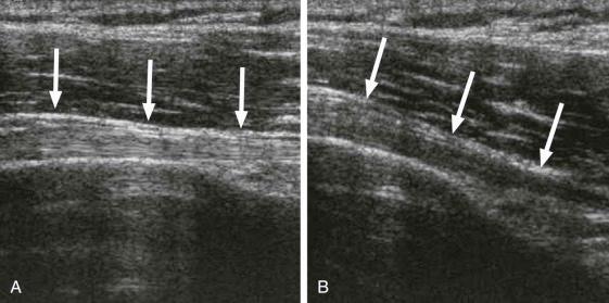 FIGURE 1–5, Anisotropy depicted on an ultrasound study of the biceps long head tendon at the shoulder. A , Ultrasound beam oriented perpendicular to the tendon shows echogenic, fibrillar collagen architecture of the tendon (arrows) . B , When the ultrasound beam is oblique to the tendon, one can see artifactual low echogenicity within the tendon (arrows) , simulating pathology.