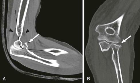 FIGURE 1–6, Reformatted CT images of the elbow acquired within a cast, limiting extension. Sagittal image ( A ) shows a coronoid process fracture (arrow) and effusion with fat pad displacement (arrowheads) . Curved reformatted coronal image ( B ) through the radiocapitellar joint (curved reformat along black line in A ) displays radial head fracture.