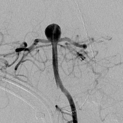 Figure 16.1, Cerebral angiogram demonstrates a basilar apex cerebral aneurysm.