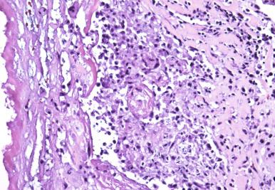 Figure 2.1, Pyogenic response in acute infective endocarditis due to Streptococcus spp. with neutrophilic exudate (×400).