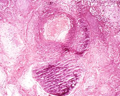 Figure 2.2, Necrotizing response to Pseudomonas aeruginosa, showing liquefactive destruction of lung tissue (×250).