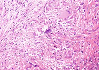 Figure 2.3, Granulomatous response to Mycobacterium tuberculosis (×25).