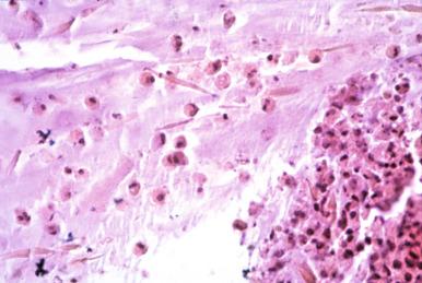 Figure 2.5, Eosinophilic response to Aspergillus fumigatus (×400).