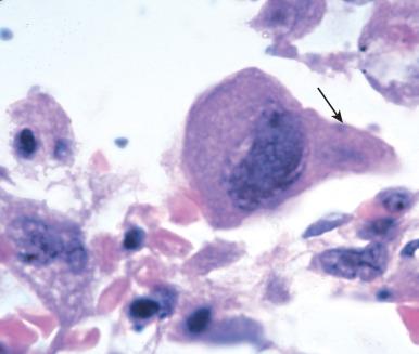 Figure 2.6, Cytopathic response to Cytomegalovirus with both nuclear and cytoplasmic (arrow) inclusions (×600).