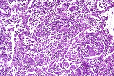 Figure 2.8, Granulohistiocytic response to Blastomyces dermatitidis (×250).