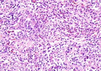 Figure 2.9, Granulomatous response with tissue eosinophilia due to Coccidioides immitis (×250).