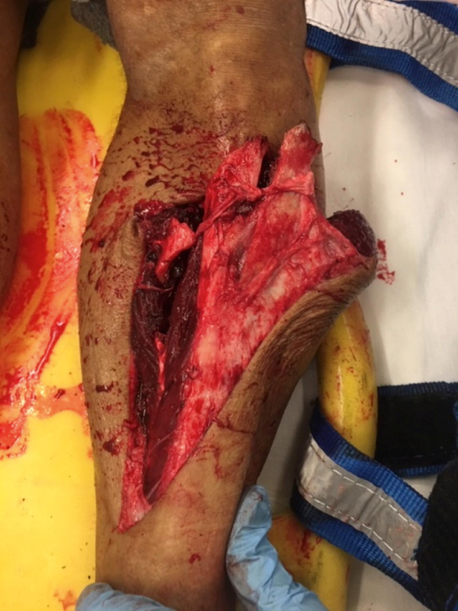 FIGURE 14.1, Lengthy warm ischemia time generally is an absolute indication for amputation.