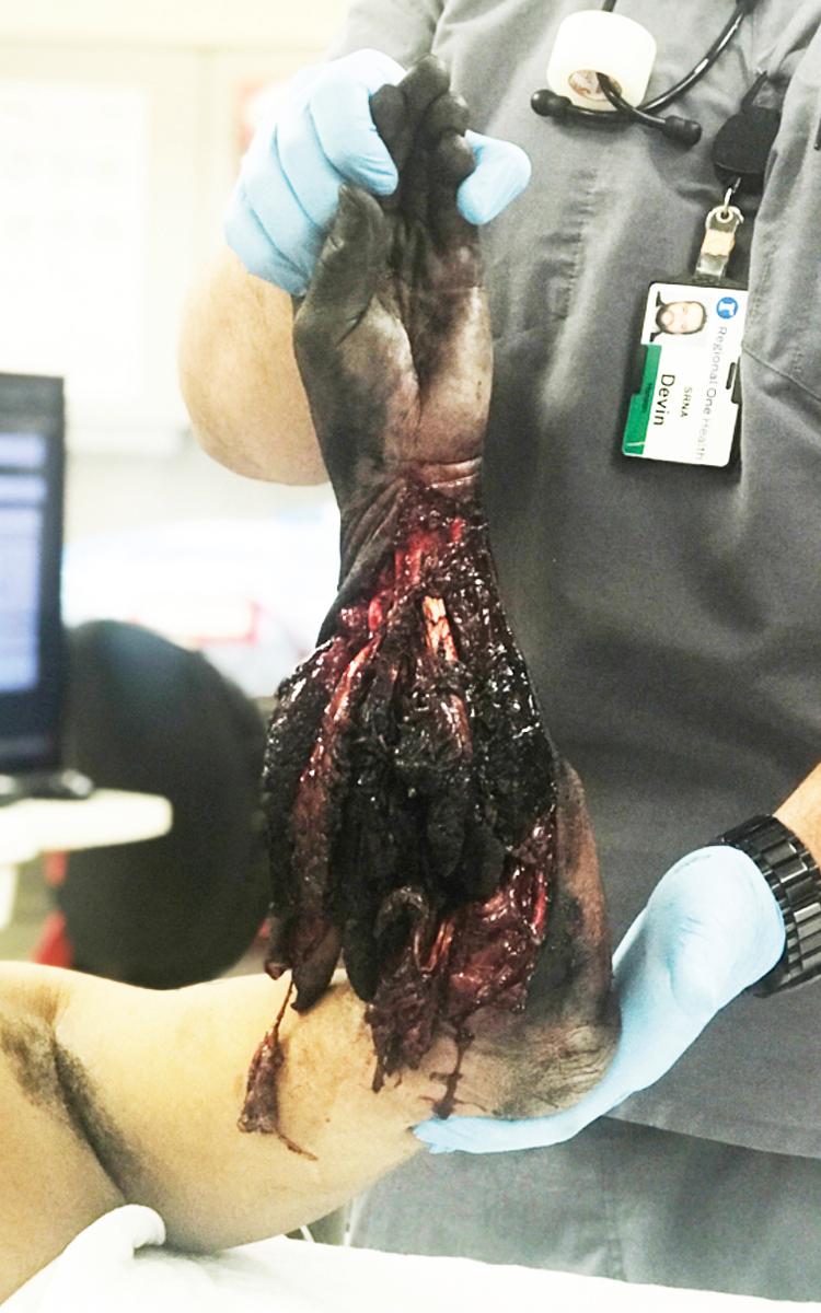 FIGURE 14.2, Electrical burn of the hand and forearm that necessitated an above-elbow amputation.