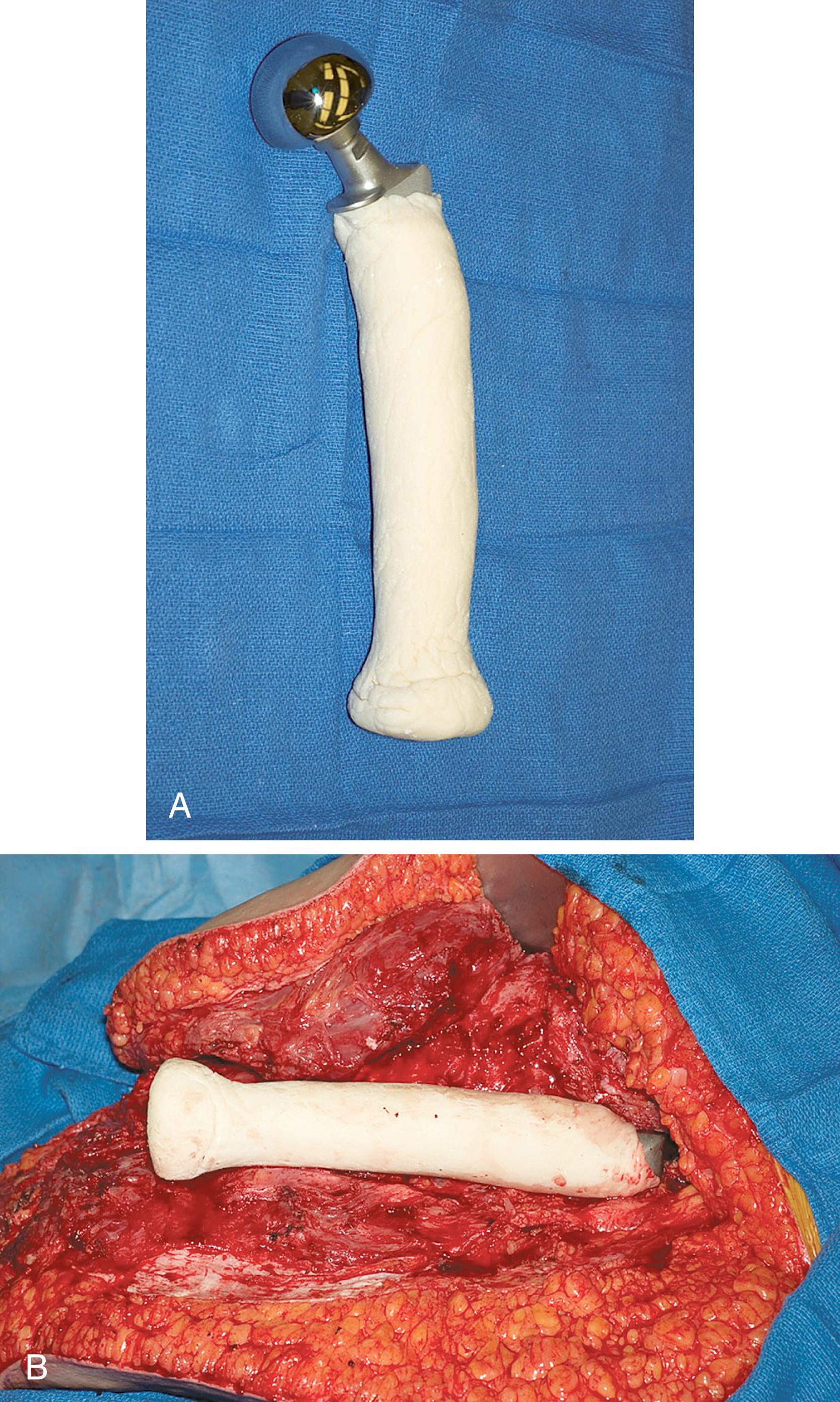 FIGURE 14.3, Hip disarticulation secondary to osteosarcoma. A, Proximal femoral replacement is constructed using hip hemiarthroplasty component and bone cement. B, Anterior and posterior flaps are repaired over prosthesis. Patient can function as transfemoral amputee.