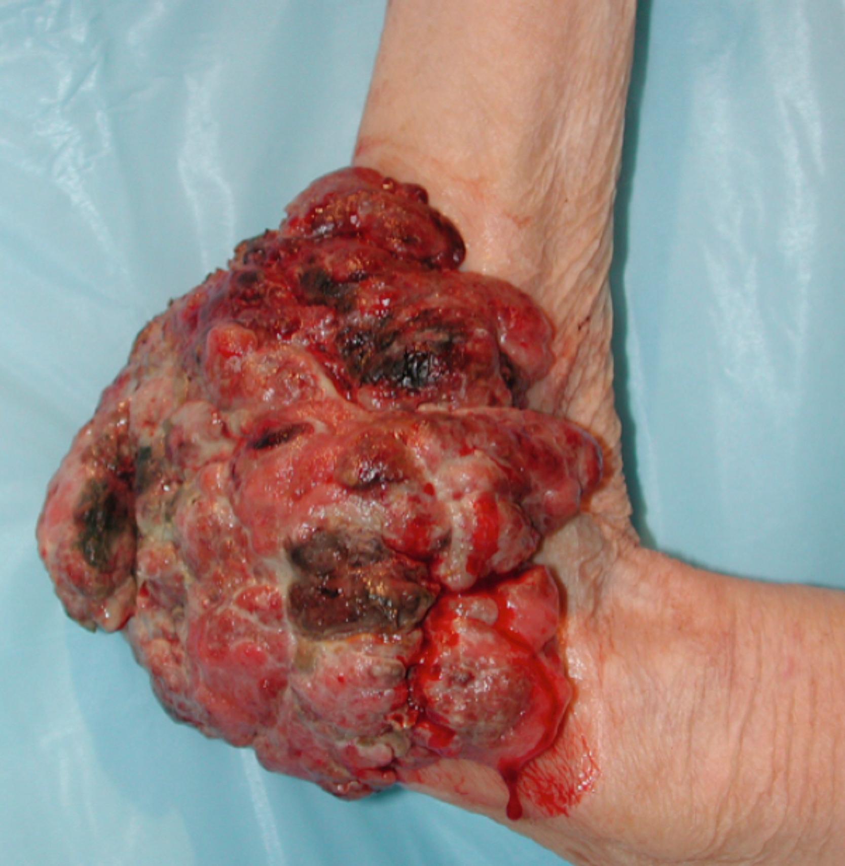 FIGURE 14.4, Fungating tumor required transhumeral amputation.