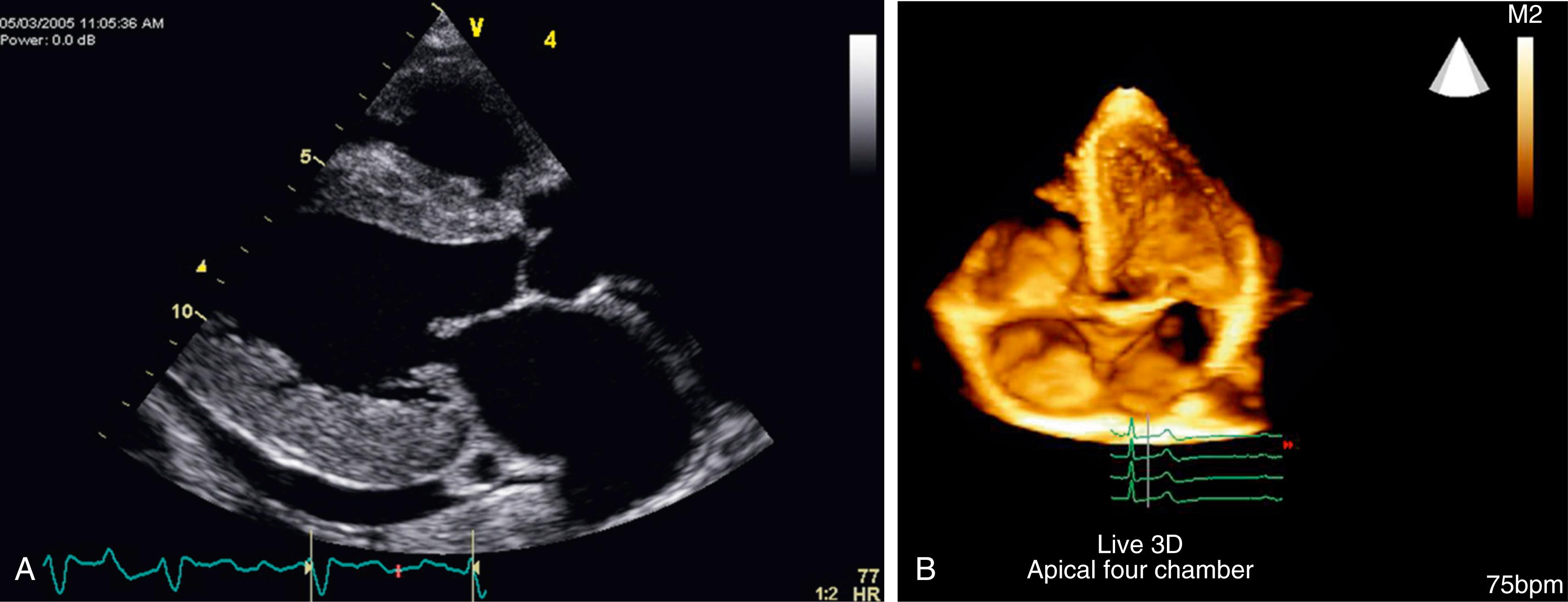 Figure 1.3, A, Two-dimensional cardiac sector image. B, Three-dimensional cardiac image.